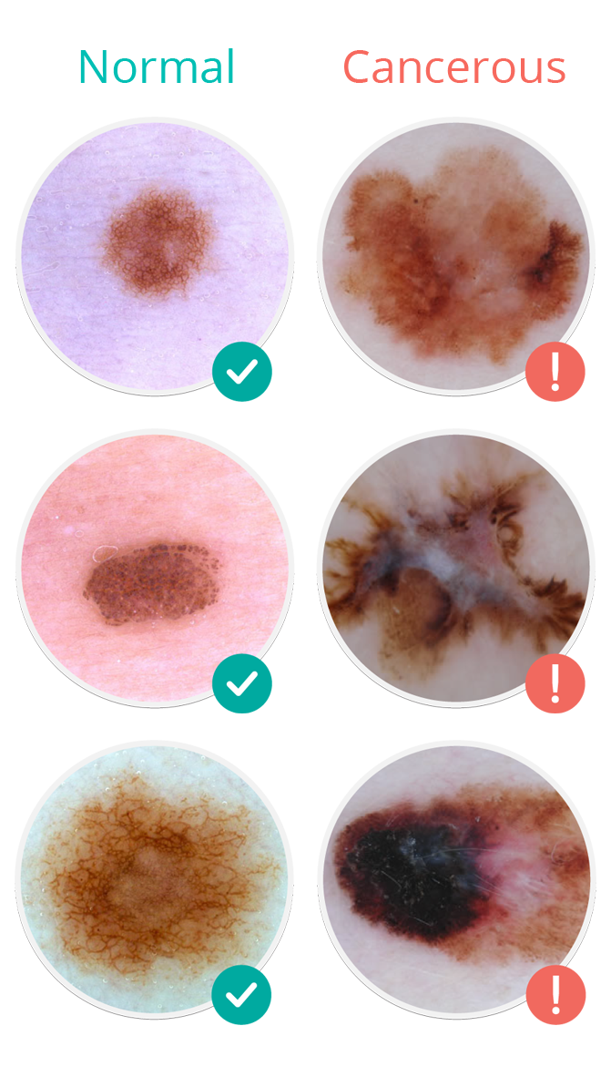 Molescope™ Skin Cancer Signs And Symptoms