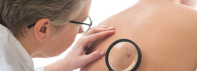 Skin Cancer Melanoma Signs And Symptoms Skin Cancer Images And Pictures