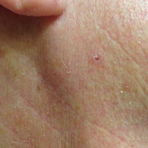 Basal Cell Carcinoma