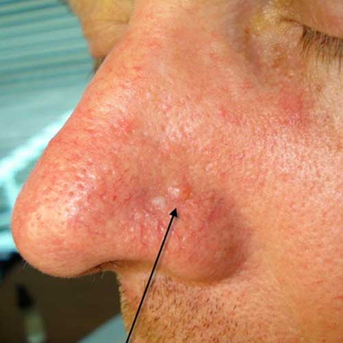 Basal Cell Carcinoma Picture Image on MedicineNet.com