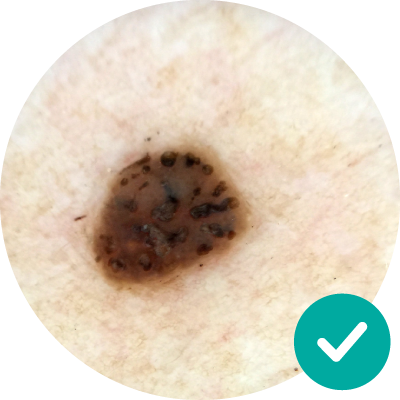 Is there a website with pictures that show the difference between melanomas and moles?