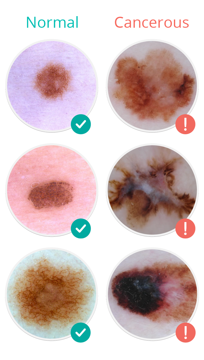 Melanoma Skin Moles