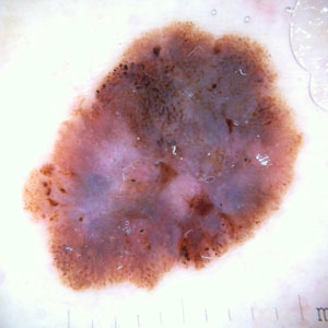 melanoma dermoscopic image