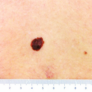 Skin Cancer Melanoma Signs And Symptoms Skin Cancer Images And Pictures