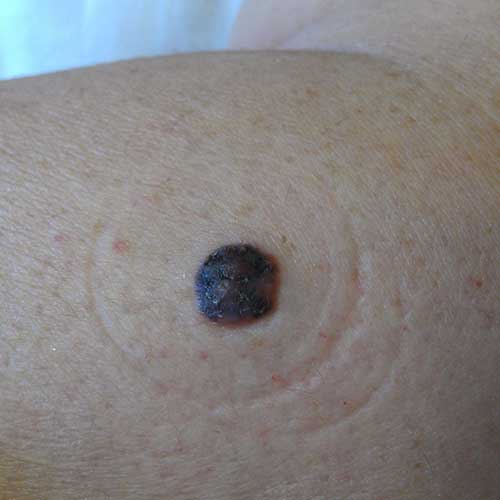 nodular melanoma flesh colored