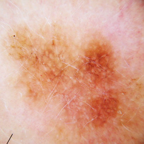 Skin Cancer Melanoma Signs And Symptoms Skin Cancer Images And Pictures