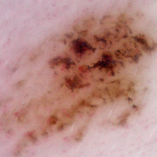 melanoma dermoscopic image