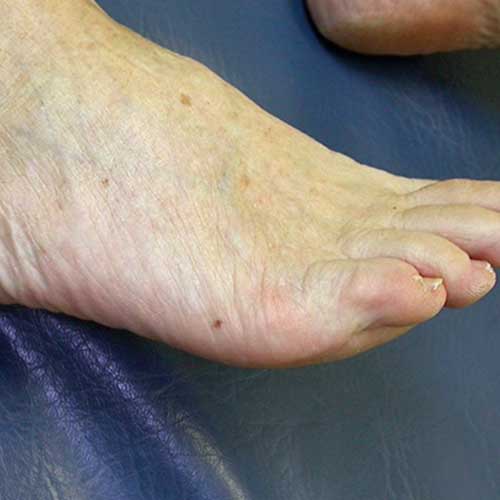 Benign Mole On Foot Discount | emergencydentistry.com